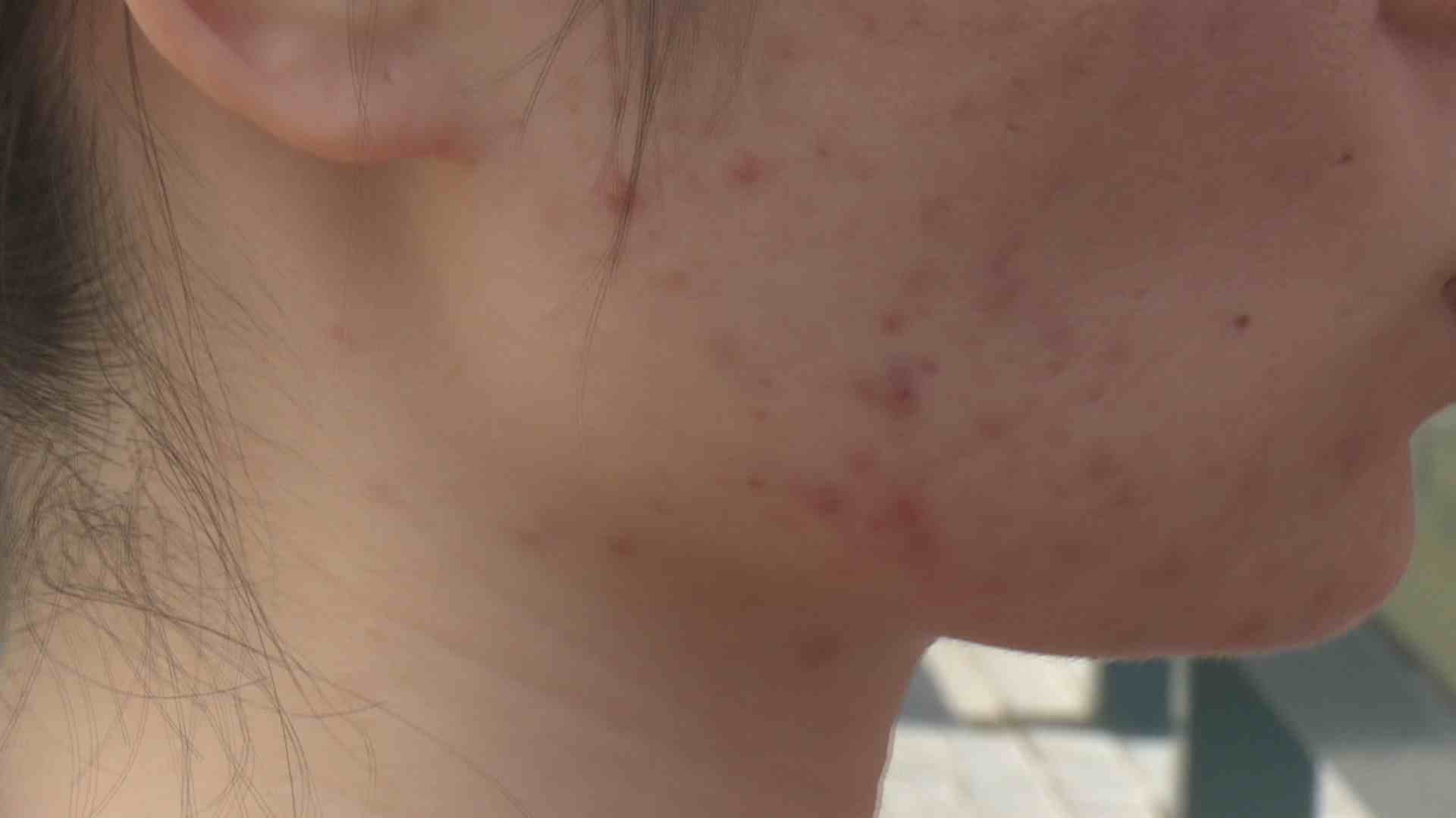 女子祛痘两个月花费八万多,银川女子花近5万元祛痘没效果