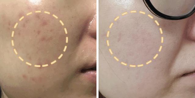 宁静说的美白方法,宁静打美白针