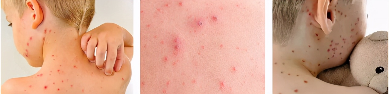 春天儿童疹子,春季儿童高发哪种疹子