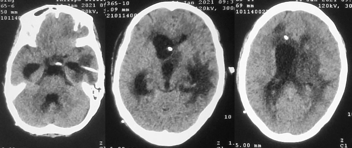脑脓肿合并脑膜炎需要手术吗,脑脓肿进入左侧脑室严重吗