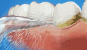 牙齿上有黑点可怕吗,牙齿上有小黑点原来这么可怕