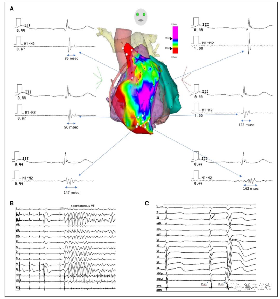 室性早搏射频消融治疗适应症,室性早搏的射频消融适应症