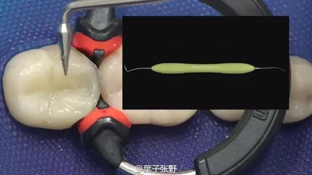 补牙疼吗补牙过程图,补牙全部过程是什么样子的