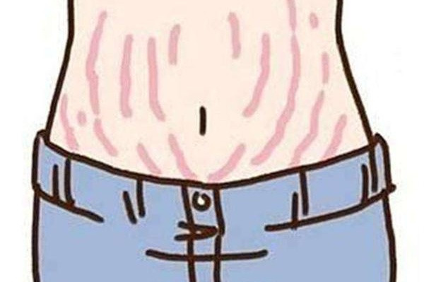 孕妈妈妊娠纹怎么缓解,孕妈妈长纹了怎么办