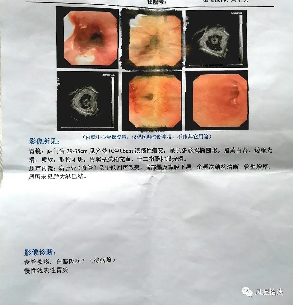 「病例分享」阴道镜和胃镜检查后发现的白塞病