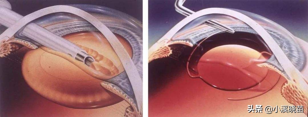 猫得了白内障怎么办,鸟得了白内障怎么办