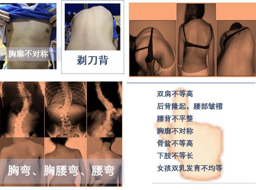 10岁孩子脊柱凸起是什么原因,10岁孩子后背脊柱突出图片