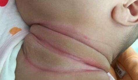 宝宝肉嘟嘟真可爱,宝宝脸蛋胖嘟嘟的原因