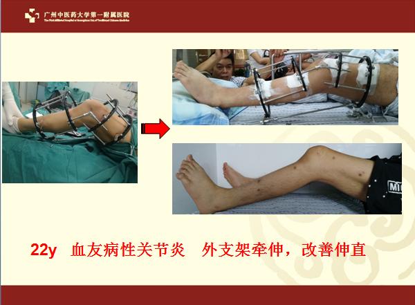 膝关节变形手术,膝关节退化变形矫正手术