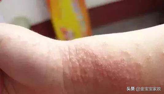 新生儿热疹和湿疹的预防与护理,婴儿湿疹的原因和护理方法