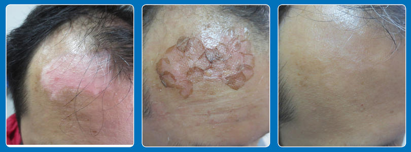 白癜风表皮移植后黑色素怎样,白癜风培植后黑色素能恢复吗