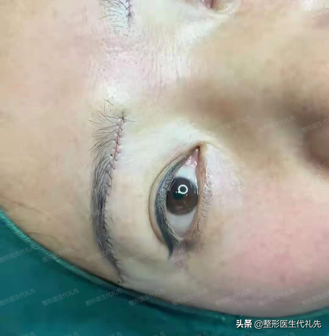 做提眉之前需要注意什么,提眉手术怎么操作