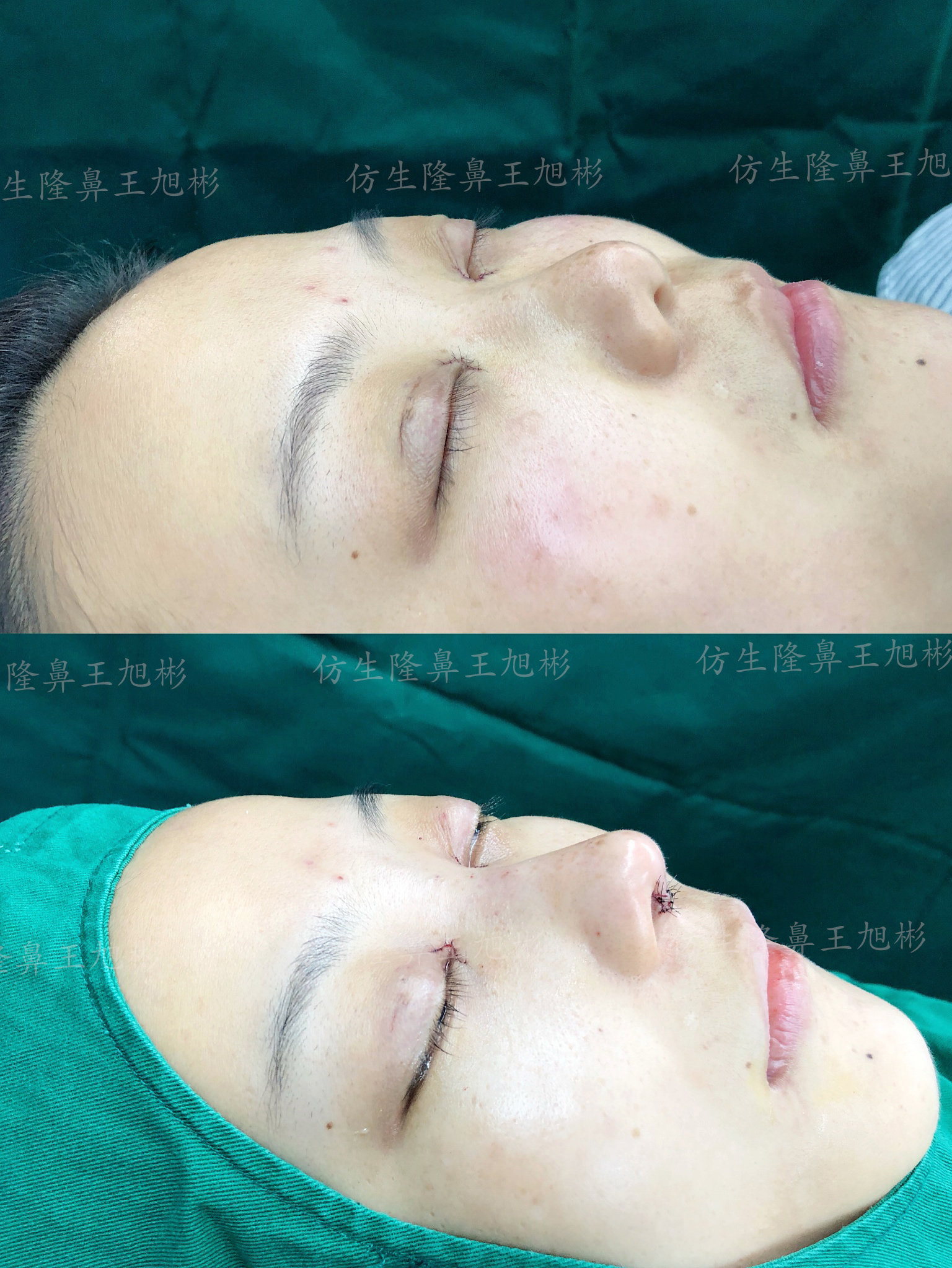 五官扁平的大饼脸,大饼脸和扁平五官怎样自救