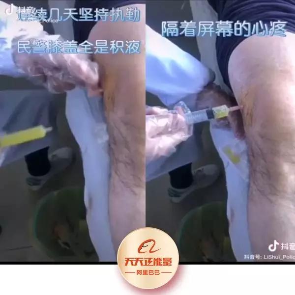 隔着屏幕的心疼!医生抽出民警膝盖里的积液,都已经化脓了