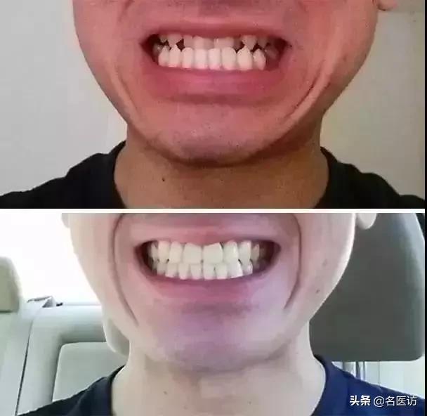 牙齿矫正换脸视频,牙齿矫正颜值有多大改变图片
