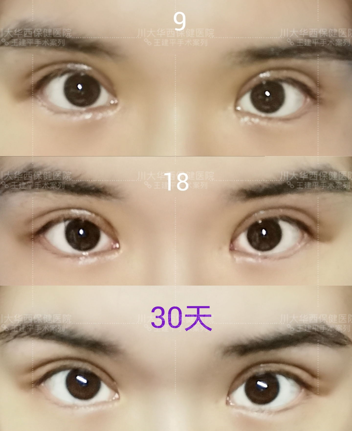 双眼皮有几种类型适合哪些脸型,各种类型的双眼皮适合啥样的人做