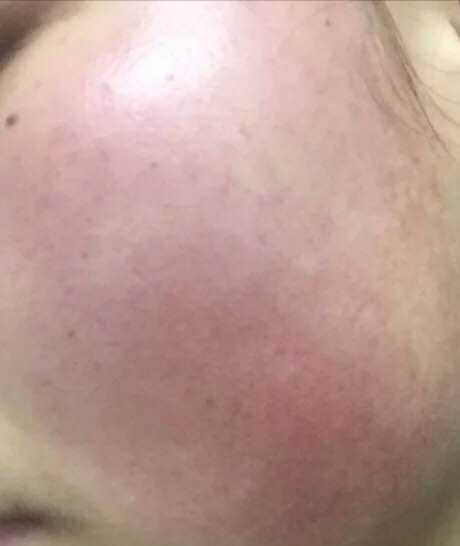 敏感肌适合的洗面奶乳液,适合红血丝皮肤的乳液