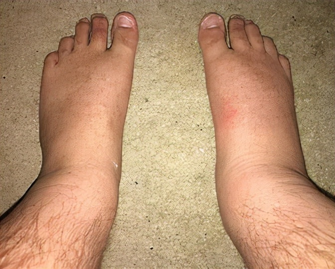 50多岁水肿是什么原因引起的,突然发胖水肿厉害什么原因