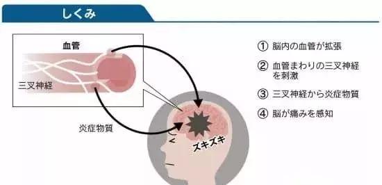 日本治疗偏头疼,偏头痛日本