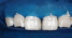 门牙缝可以补吗,为什么门牙有缝