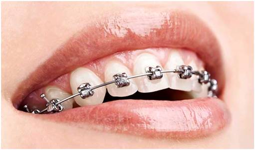 什么叫做矫正牙,什么是牙齿矫正过程