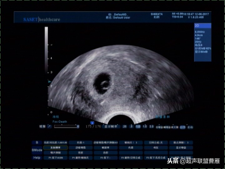 3毫米卵黄囊未见胎芽正常么,40多天的卵黄囊