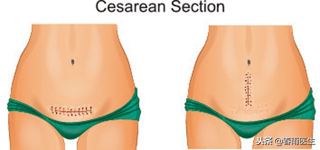 生完宝宝要不要缠腹带,生完孩子绑腹带肚子可以收回去吗