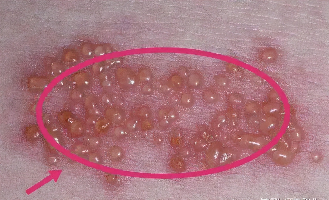 水痘好了下个月可以移植了吗,水痘愈合后还有痘吗