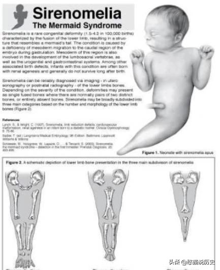 美人鱼真实存在的5件事,美人鱼婴儿畸形手术