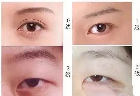割双眼皮是种什么体验,割双眼皮什么样子才是增生