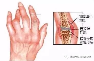 沈阳京城医院治疗类风湿靠谱吗,沈阳京城风湿病医院视频