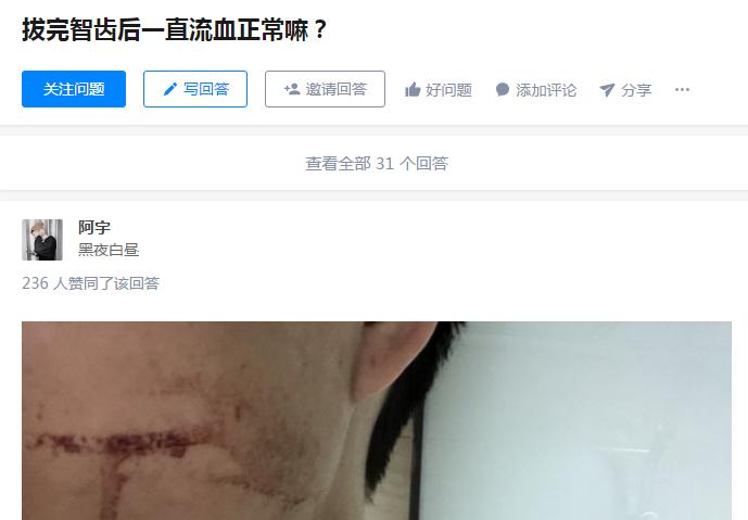 26岁男子拔智齿流血多日后离世,拔完智齿过几天又流血是什么病