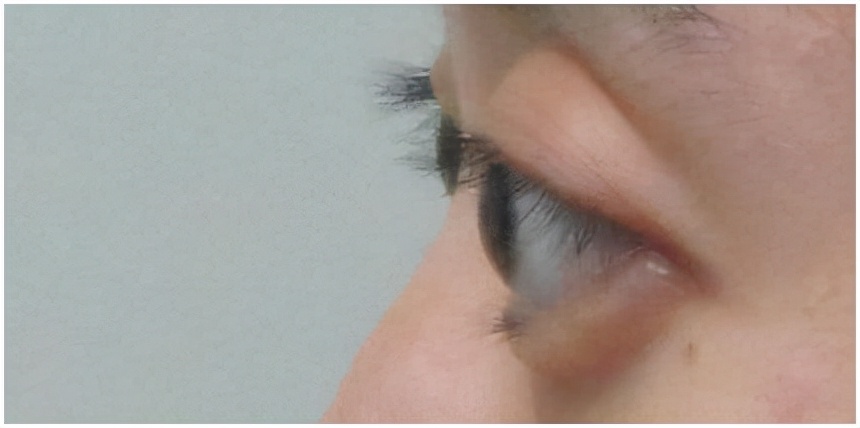 眼凸的人适合哪种双眼皮,眼凸但不近视是什么原因