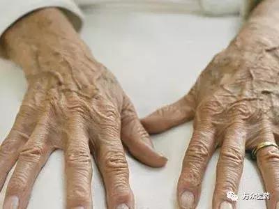 平常做动作预防老年人手上老年斑,手上老年斑的形成原因及消除方法