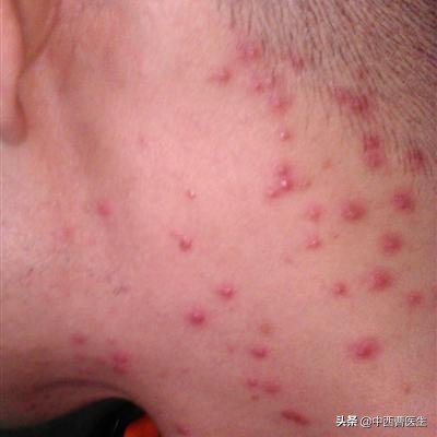 梅毒是性病吗？如何传染对人体的危害，是什么？