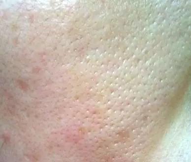 毛孔粗大怎么补充胶原蛋白,脸部肌肤松弛胶原蛋白流失怎么办