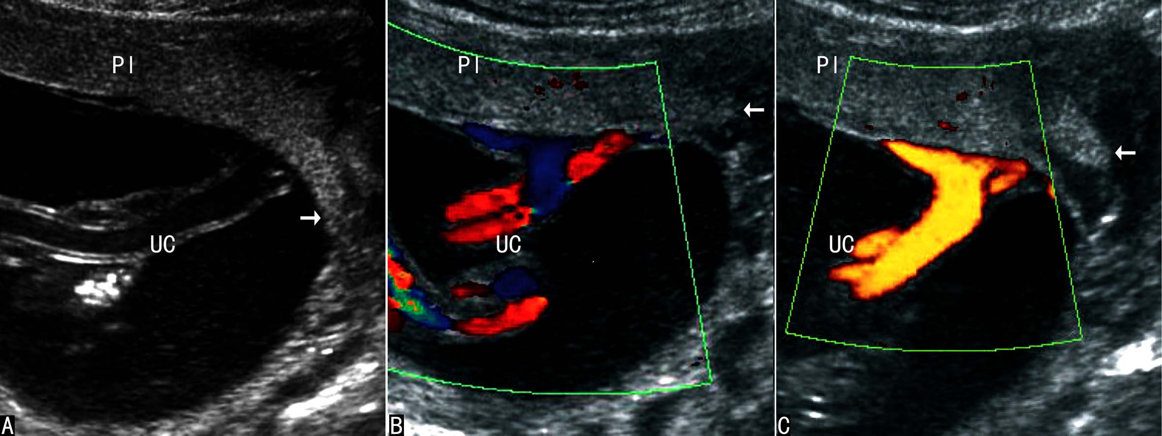做高清彩超能看出脐带扭转吗,脐带超声异常