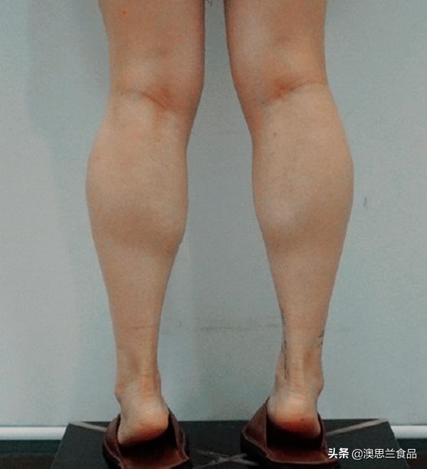 小腿肌胖怎么瘦腿,大腿肥胖小腿粗壮怎么改善