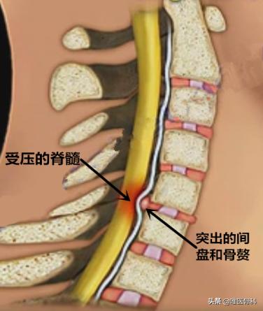颈椎病做手术哪种方式最好,开放手术和微创手术的区别