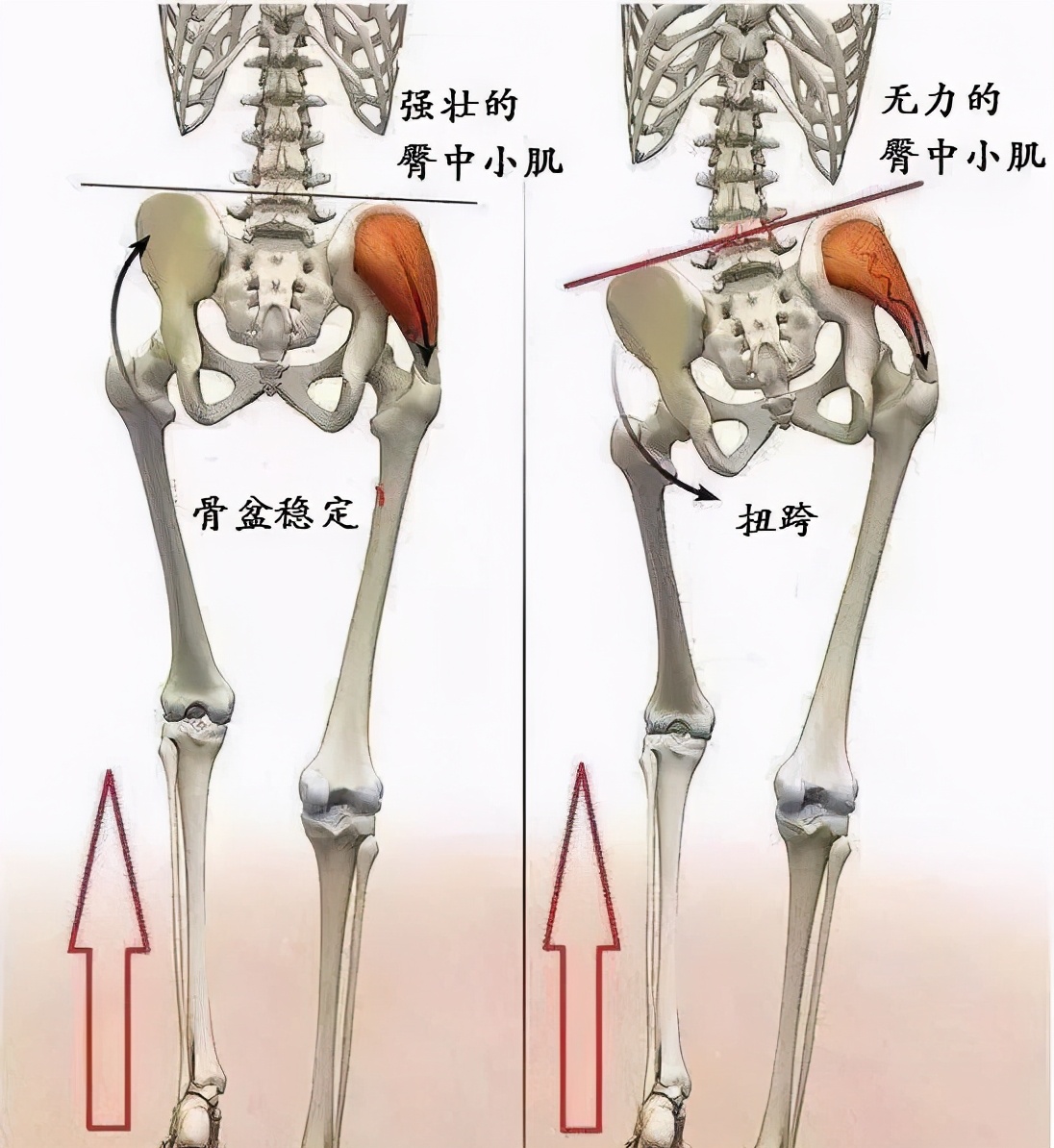 臀大肌无力会对步行有什么影响,臀大肌无力会引起腿疼吗