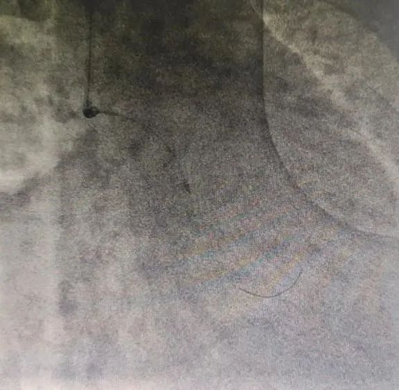 北京积水潭医院心内科成功开展医疗新技术！准分子激光冠脉消蚀术与冠脉旋磨术治疗冠脉钙化病变