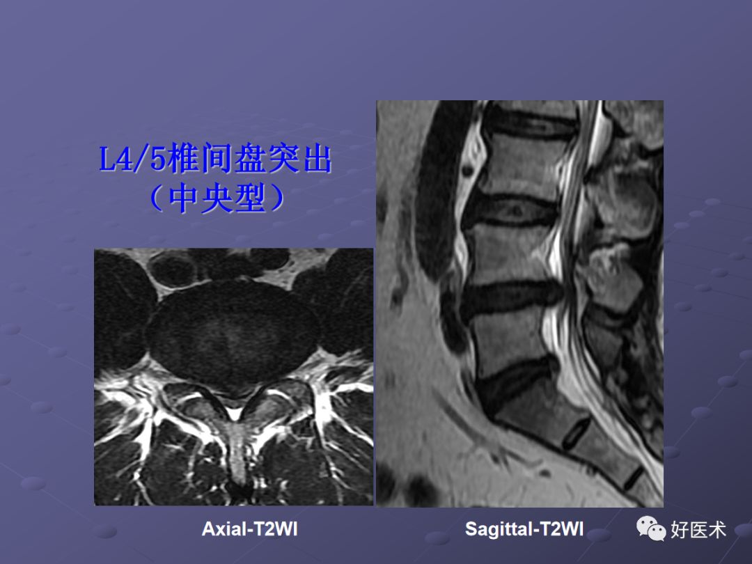 脊柱mri有哪些特点,乳腺疾病的mri诊断及鉴别
