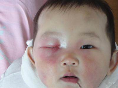 宝宝出生时头上挤了个包,宝宝出生时头上的包变硬咋回事