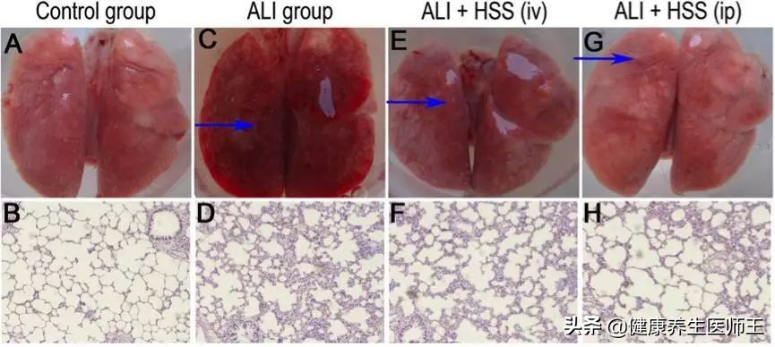 急性肺损伤诊断标准,急性肺损伤辨证