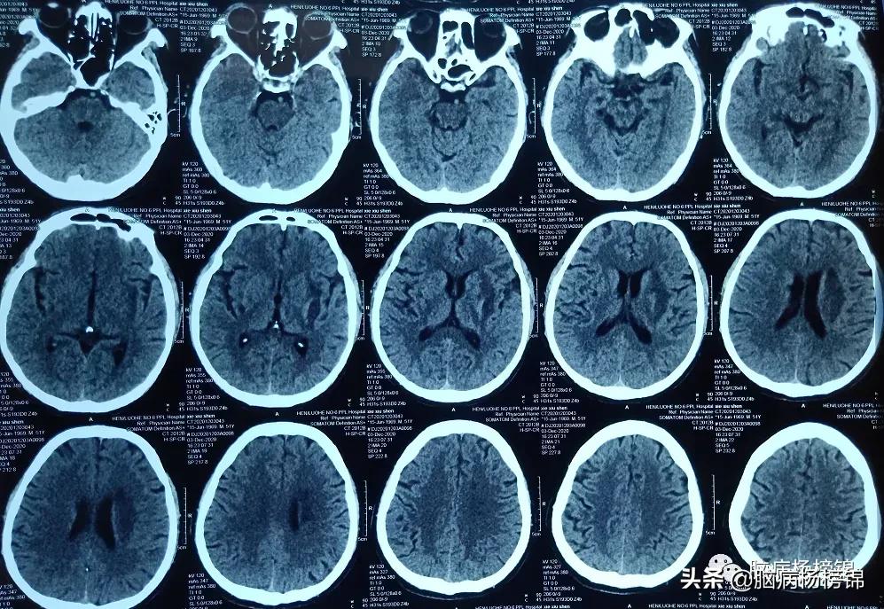 高空掉落脑出血,高处作业会不会引起脑溢血