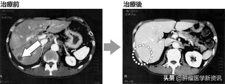 全世界治疗癌症的药物,日本癌细胞免疫疗法