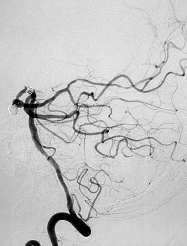 颅内巨大动脉瘤首选治疗技术,大脑中动脉动脉瘤闭塞的介入治疗