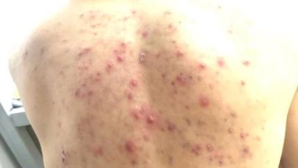 毛囊炎出现红色丘疹会自己痊愈吗,红色的丘疹是毛囊炎