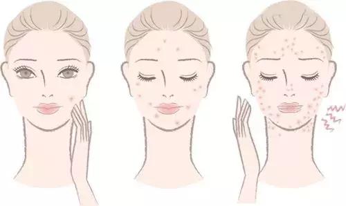 祛痘印最有效的方法,有什么祛痘印最有效的方法