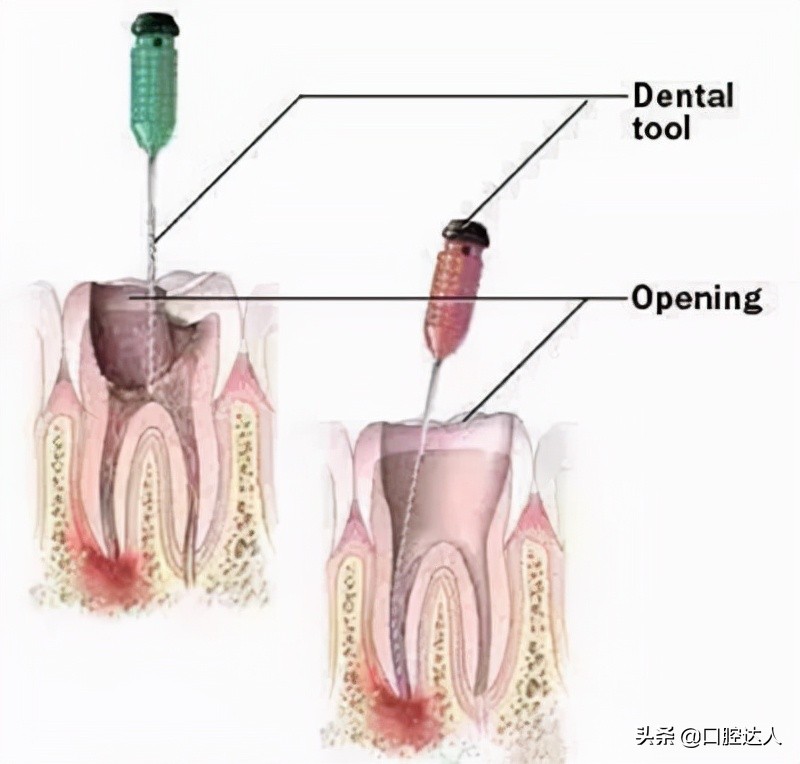 牙齿松动发炎肿痛吃什么消炎药,牙齿发炎松动吃什么消炎药
